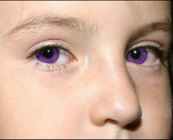 Болезни, связанные с желтыми белками глаз